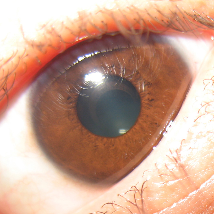 the eye